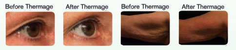 thermage